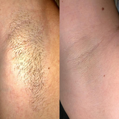 Before And After Underarm
